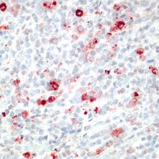 Orbital lesion, tryptase IHC